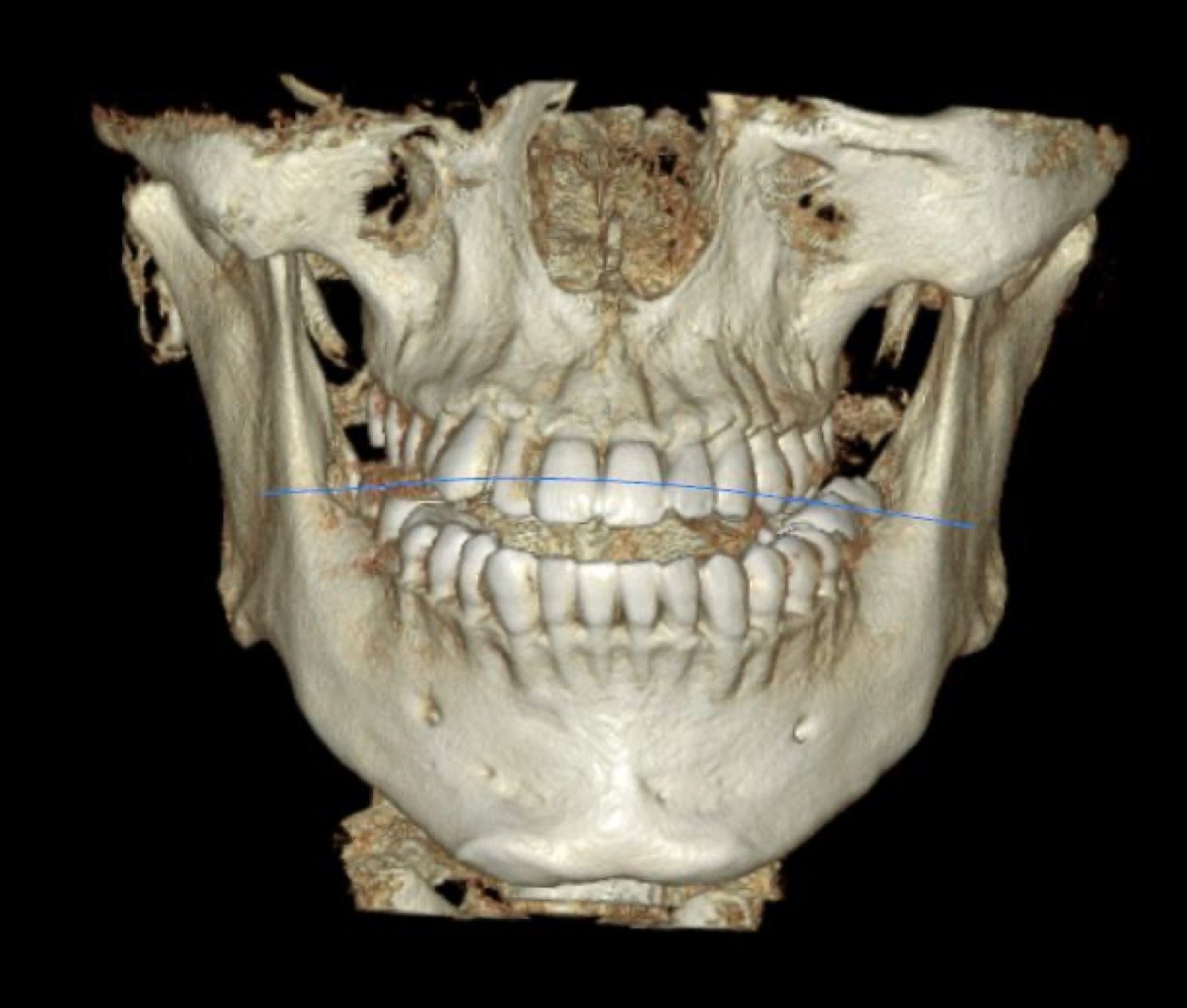 Reconstrucción 3D de un cráneo hecha con tomografía cone beam